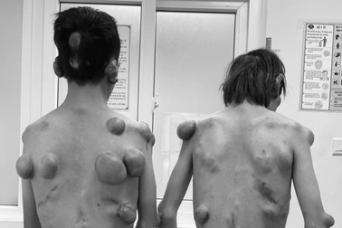 Hai anh em sinh đôi "người củi" với hàng trăm khối u trên cơ thể