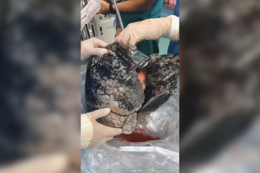 “Sốc” video phổi đen như than của người hút thuốc