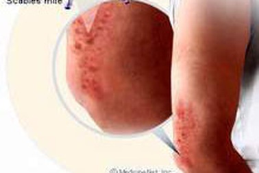 Ghẻ và cách điều trị trong cộng đồng 