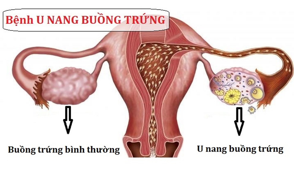 Dấu hiệu cảnh báo u nang buồng trứng và cách cải thiện từ thảo dược - 1 Dấu hiệu cảnh báo u nang buồng trứng và cách cải thiện từ thảo dược - 1