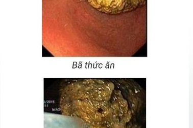 Khối bã quả hồng to như quả trứng trong dạ dày bé trai