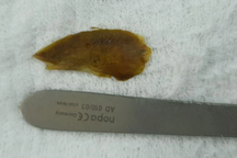 Thủng ruột vì món ăn quen thuộc trên mâm cơm