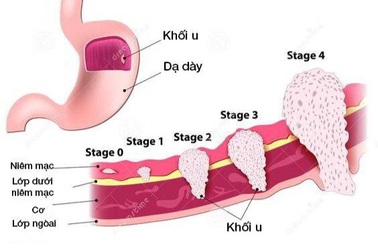 5 giai đoạn của ung thư dạ dày, phát hiện sớm sẽ chữa khỏi