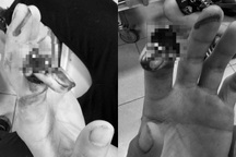 Mang găng tay quá rộng, nam thanh niên gặp tai nạn đứt ngón trỏ