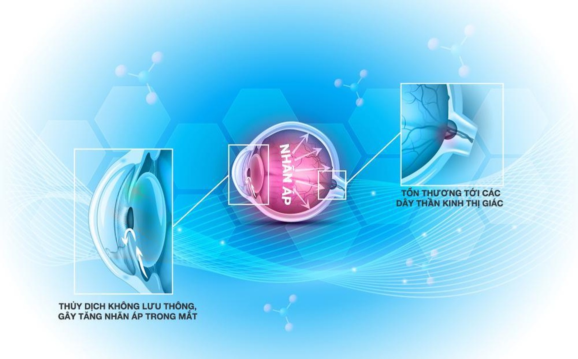 Chủ động tầm soát để tránh nguy cơ mất thị lực do Glôcôm - 1 Chủ động tầm soát để tránh nguy cơ mất thị lực do Glôcôm - 1