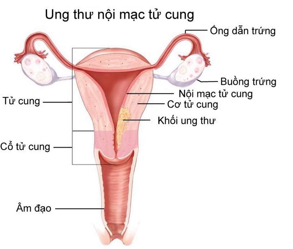 Bệnh nhẹ hóa ung thư chỉ vì không nghe bác sĩ nhập viện điều trị - 1 Bệnh nhẹ hóa ung thư chỉ vì không nghe bác sĩ nhập viện điều trị - 1