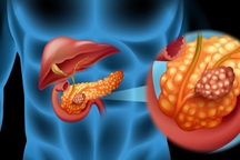 Các triệu chứng mơ hồ của ung thư tuyến tụy