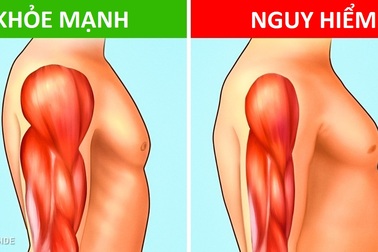 Khối lượng cơ: Nhân tố quan trọng trong phòng chống bệnh mạn tính, kể cả ung thư