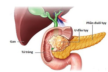 Phẫu thuật nội soi cắt khối tá tụy - Bước tiến mới trong điều trị ung thư vùng đầu tụy tá tràng