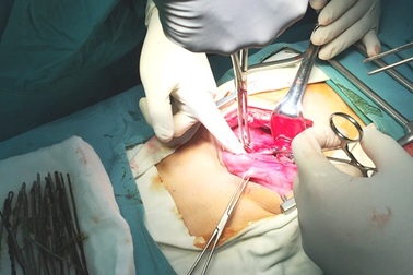 Phẫu thuật lấy 30 que sắt trong bụng bệnh nhân ngáo đá