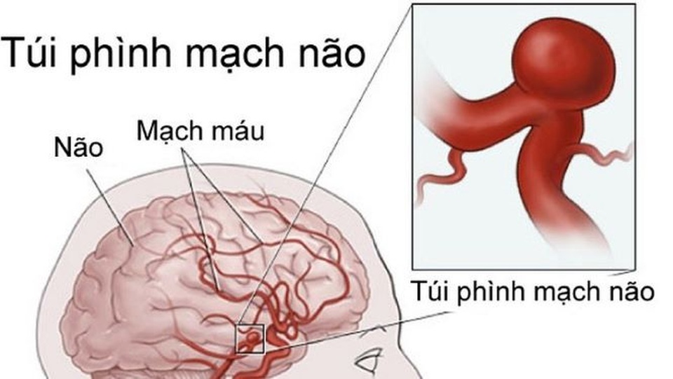 Nguy cơ phình mạch máu do sử dụng thuốc ung thư - 1 Nguy cơ phình mạch máu do sử dụng thuốc ung thư - 1