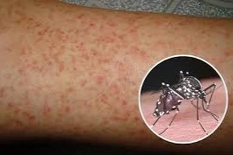 Đồng Tháp: Sốt xuất huyết tăng 4-5 lần, cảnh báo biến chứng nặng