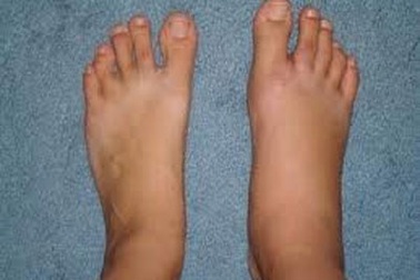 5 nguyên nhân gây phù bàn chân và mắt cá chân