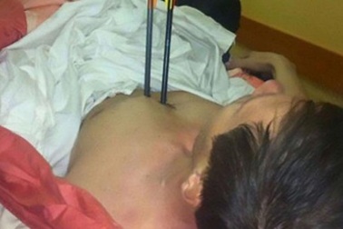 Tự bắn 2 phát tên xuyên ngực nhưng không chết được