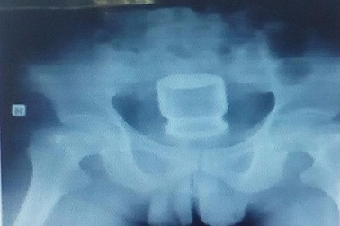 Dùng lọ nước yến thông hậu môn để trị… táo bón