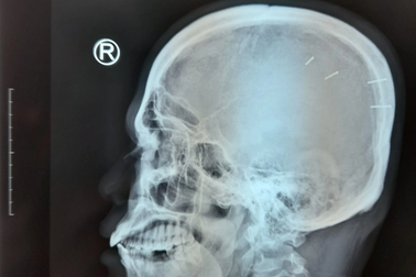 Người đàn ông tự bắn 4 cây đinh vào đầu vì… cô đơn