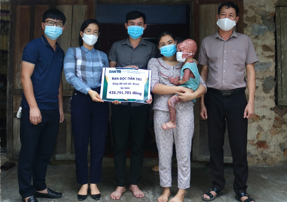 Cháu bé 2 tuổi bị bỏng xăng nặng được bạn đọc giúp đỡ gần 500 triệu đồng - 1 Cháu bé 2 tuổi bị bỏng xăng nặng được bạn đọc giúp đỡ gần 500 triệu đồng - 1