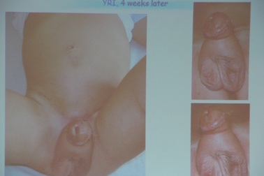 Hỗ trợ tái tạo bộ phận sinh dục cho trẻ em