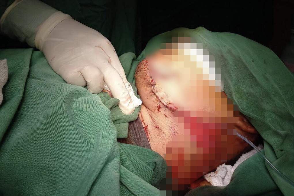 Ngã giàn công trình, nam thanh niên bị ống sắt đâm xuyên cổ kinh hoàng - 2 Ngã giàn công trình, nam thanh niên bị ống sắt đâm xuyên cổ kinh hoàng - 2