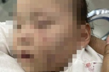 Xác minh vụ bé gái với nhiều vết bầm trên mặt sau khi đi lớp