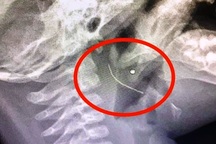 Gắp thành công đoạn thép dài 2cm trong vùng họng cháu bé 13 tháng tuổi