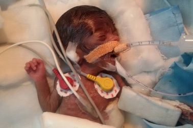 Em bé "bé nhất hành tinh" được phẫu thuật tim thành công