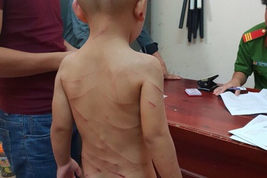 Bé 3 tuổi bị cha dượng đánh dã man: Nạn nhân thương tật 24%