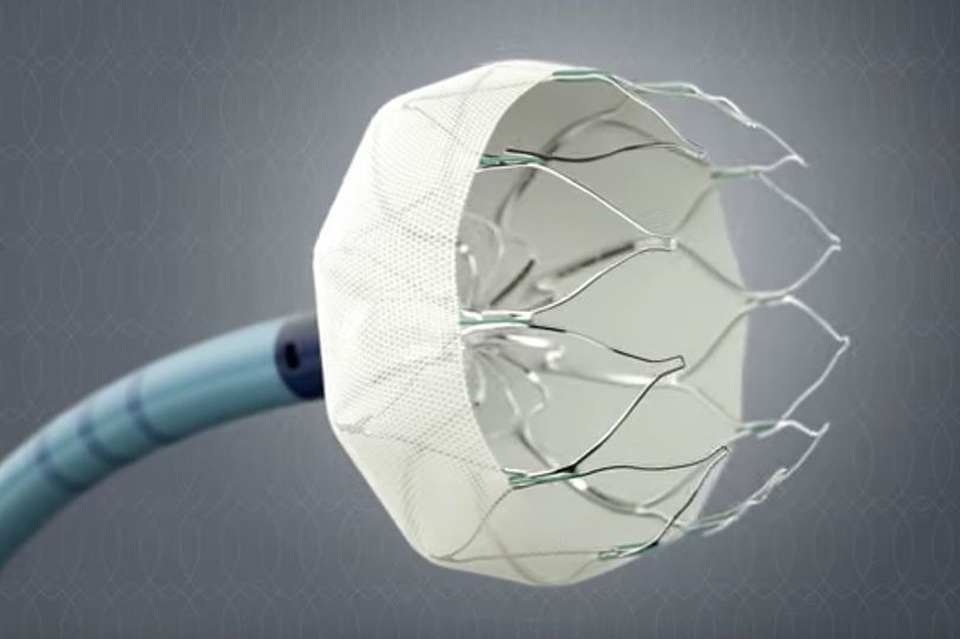 Phương pháp cấy ghép tim đột phá giúp giảm nguy cơ đột quỵ đến 70% - 1