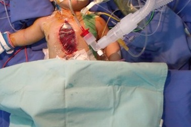 Trẻ dưới 16 tuổi được ngân sách hỗ trợ phẫu thuật tim