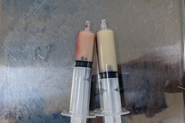 Căn bệnh làm người mắc có máu đục như sữa: Lời cảnh báo khi bị tiểu đường