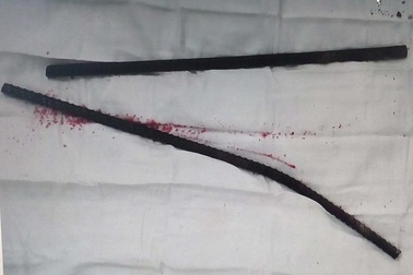 Té từ trên cao, bị 2 thanh sắt đâm xuyên đùi hông