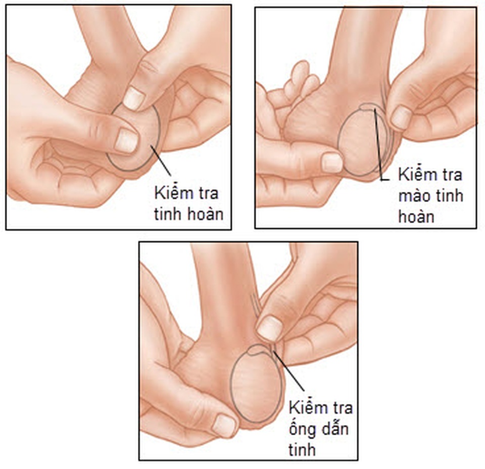 Ung thư tinh hoàn: Nguyên nhân, triệu chứng, phát hiện sớm bệnh - 2 Ung thư tinh hoàn: Nguyên nhân, triệu chứng, phát hiện sớm bệnh - 2