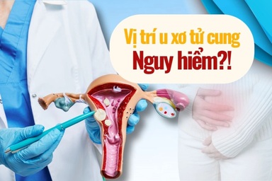U xơ tử cung nhỏ nhưng vẫn nguy hiểm nếu nằm ở vị trí nhạy cảm