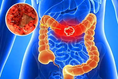 Chủ quan khi đi đại tiện, một người đàn ông suýt mất mạng