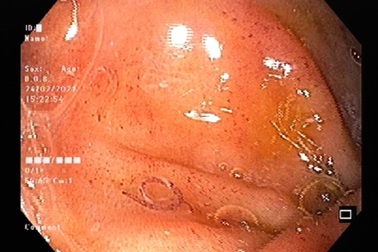 Bác sĩ ngỡ ngàng thấy hàng trăm con giun tóc trong đại tràng bệnh nhân