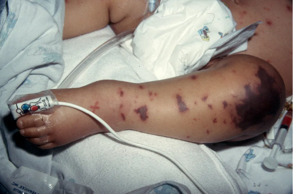 Vaccine não mô cầu nhóm B thế hệ mới lần đầu tiên có mặt tại Việt Nam - 3 Vaccine não mô cầu nhóm B thế hệ mới lần đầu tiên có mặt tại Việt Nam - 3