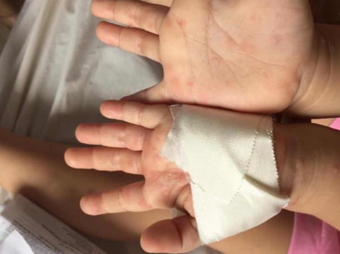 Hơn 5.500 trẻ mắc tay chân miệng, Bộ Y tế chỉ đạo khẩn - 1 Hơn 5.500 trẻ mắc tay chân miệng, Bộ Y tế chỉ đạo khẩn - 1