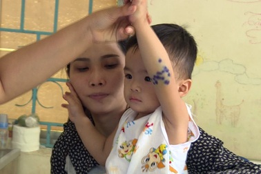 Cảnh báo nguy cơ bùng phát bệnh tay chân miệng ở Phú Yên