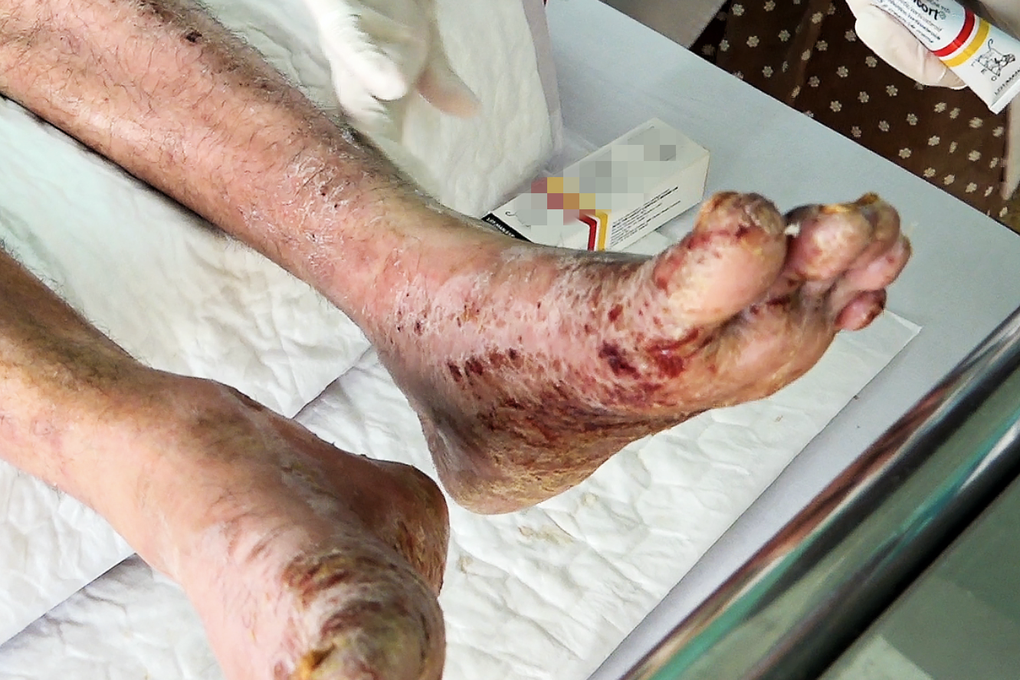 Căn bệnh khiến người đàn ông tự chích tay, chân vì ngứa muốn phát điên - 1