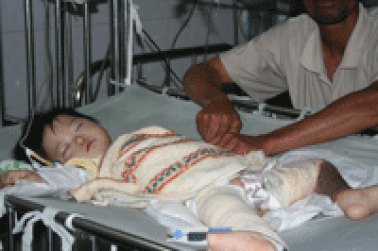 Bệnh nhân bỏng sau điều trị: 10% muốn tự tử