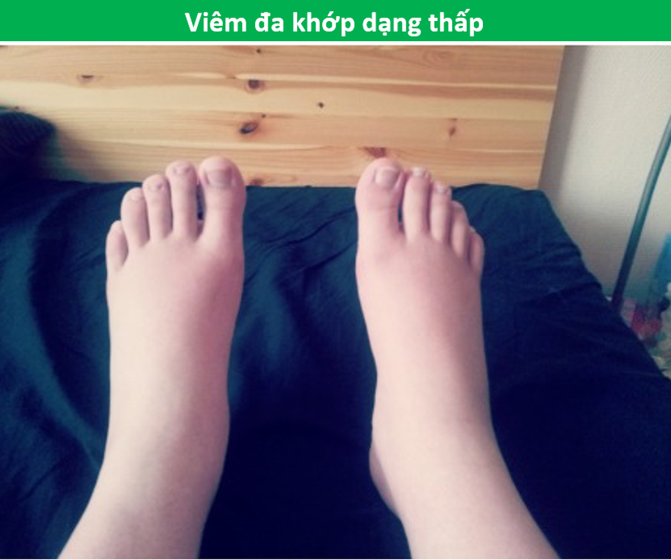 Bàn chân đột nhiên bị sưng, phù không rõ nguyên do cảnh báo bệnh gì? - 6 Bàn chân đột nhiên bị sưng, phù không rõ nguyên do cảnh báo bệnh gì? - 6