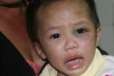 Bé gái 2 tuổi bị cắt ngón chân, đánh hộc máu