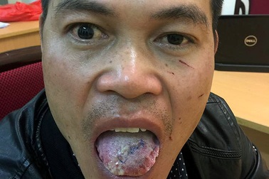 Hà Nội: Cô gái cắn gần đứt lưỡi kẻ hiếp dâm