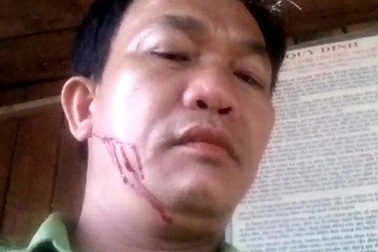 Lâm tặc hành hung kiểm lâm trọng thương
