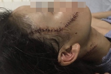 Đang âu yếm, rạch mặt người tình vì ghen