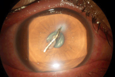 Bệnh nhi bị dao nhọn cắm phập vào mắt