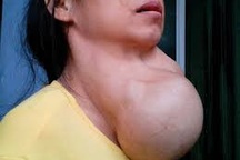 Lo ngại trở lại thiếu I - ốt, gia tăng bướu cổ, đần độn