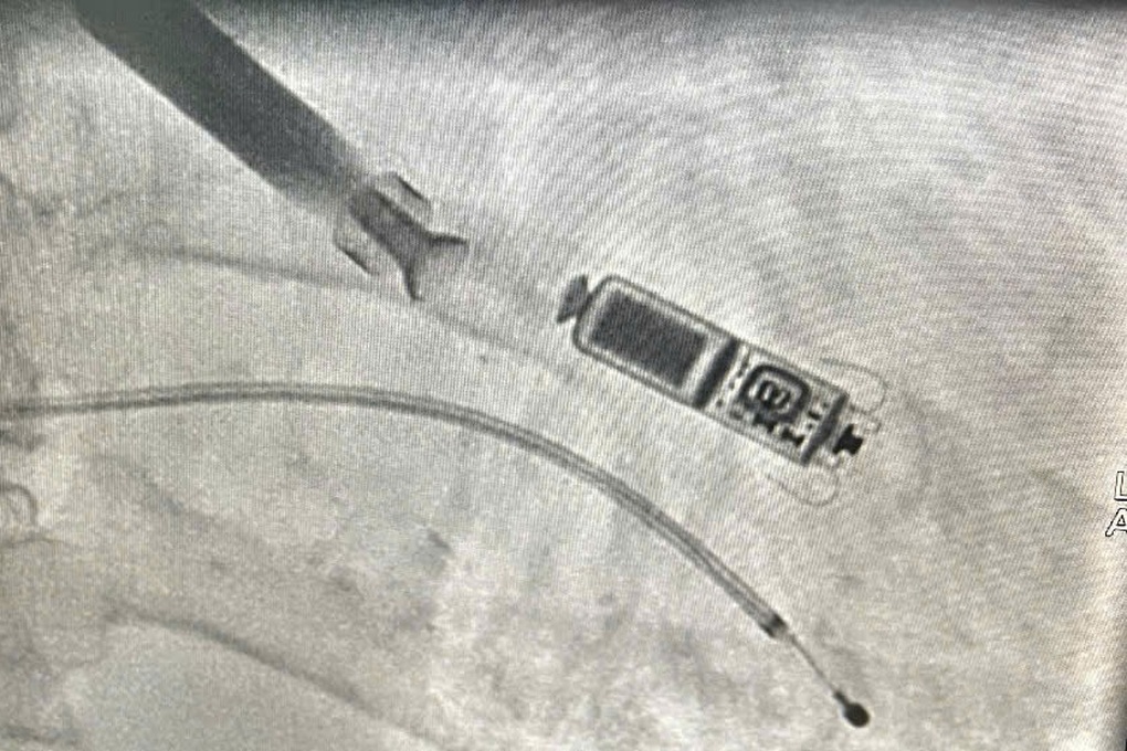 ឧបករណ៍តូចទំហំប៉ុនកន្សោមជួយស្ត្រីអាយុ ៨៣ ឆ្នាំរួចផុតពីការស្លាប់ភ្លាមៗ - ៣ Thiết bị nhỏ bằng viên thuốc con nhộng giúp cụ bà 83 tuổi thoát đột tử - 3