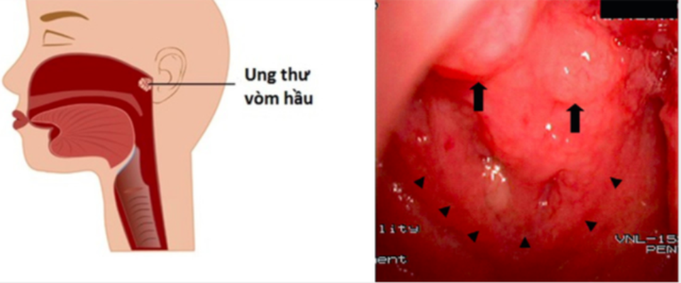 Dấu hiệu chỉ điểm căn bệnh ung thư mỹ nam Người thừa kế phải chống chọi hơn 3 năm - 2 Dấu hiệu chỉ điểm căn bệnh ung thư mỹ nam Người thừa kế phải chống chọi hơn 3 năm - 2