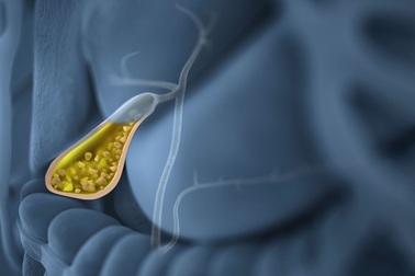 Phẫu thuật - Cách đơn giản để xử lý sỏi túi mật triệt để và nhanh chóng